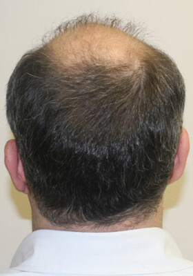 hair transplant before after Photos