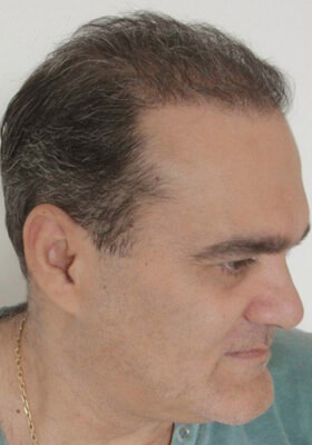 hair transplant before after Photos