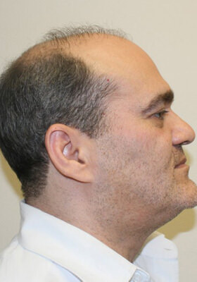 hair transplant photos