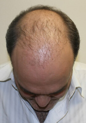 hair transplant photos