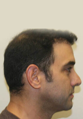 hair transplant photos