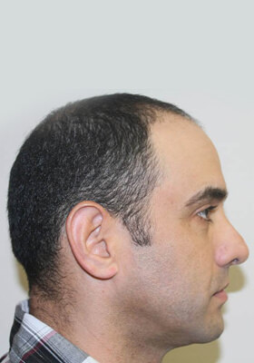 hair transplant photos