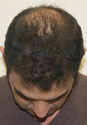 hair transplant before after Photos