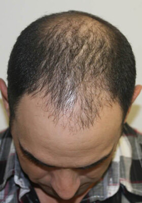 hair transplant before after Photos