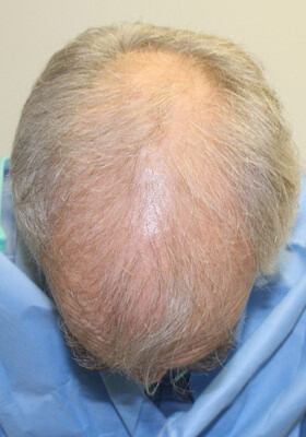 hair transplant photos