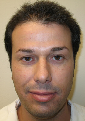 Dr Brett Bolton Patient Photos  - 1 Procedure - 5yr later!