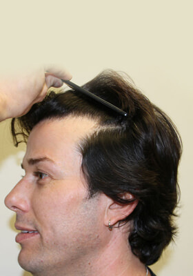 hair transplant photos