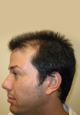 hair transplant photos