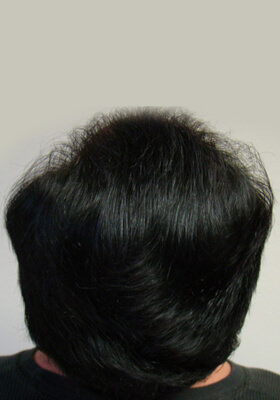 hair transplant photos