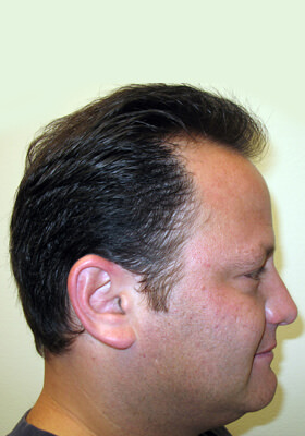 hair transplant photos