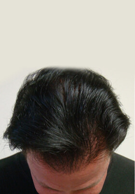 hair transplant photos