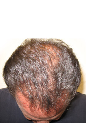 hair transplant before after Photos