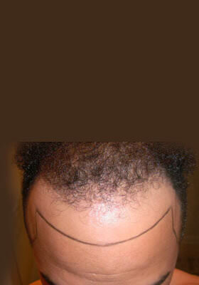 hair transplant before after Photos