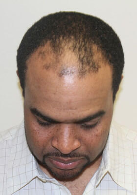 hair transplant before after Photos