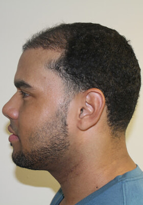 hair transplant before after Photos