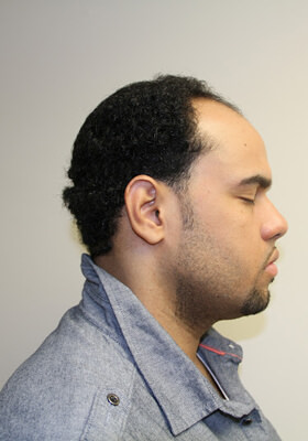 hair transplant before after Photos