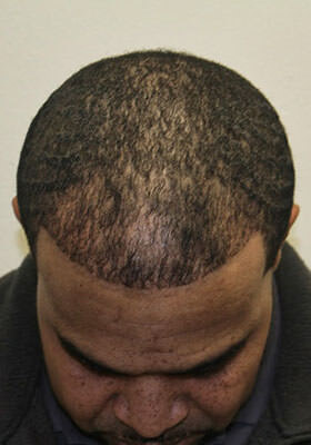 hair transplant before after Photos