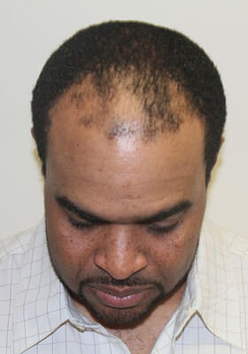 hair transplant before after Photos