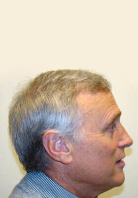 hair transplant photos