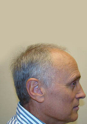 hair transplant photos