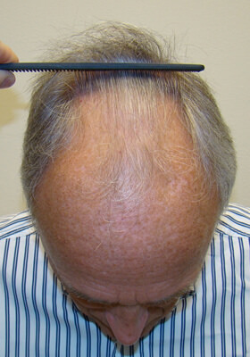 hair transplant photos