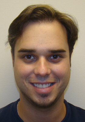Hair Transplant Before After Photos - One Procedures
