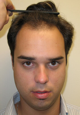 hair transplant photos