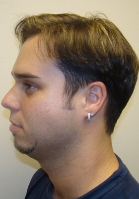 hair transplant photos