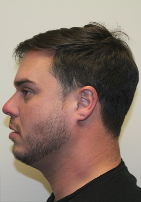 hair transplant photos