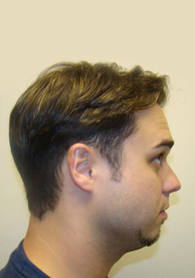 hair transplant photos