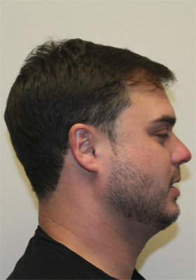 hair transplant photos