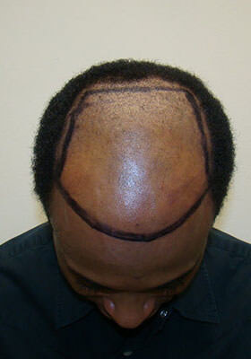 hair transplant before after Photos