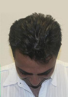 hair transplant before after Photos