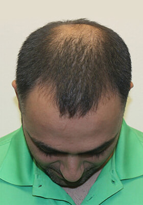 hair transplant before after Photos