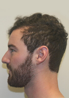 hair transplant photos