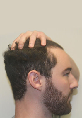 hair transplant photos