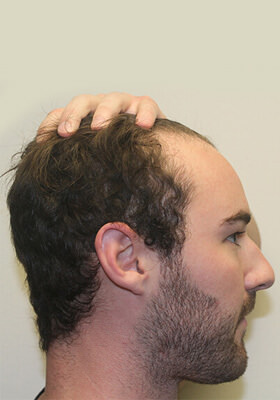 hair transplant photos