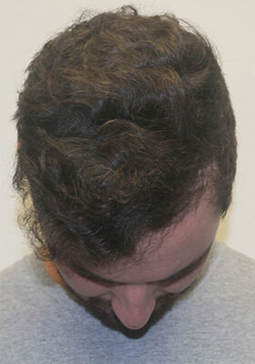 hair transplant photos