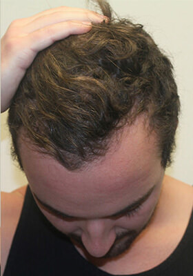 hair transplant photos