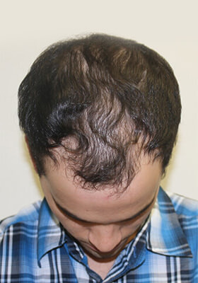 hair transplant before after Photos