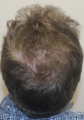 hair transplant before after Photos