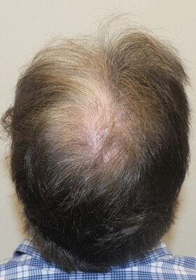 hair transplant photos