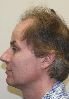 hair transplant before after Photos