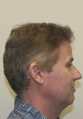hair transplant before after Photos