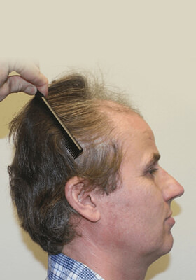 hair transplant photos