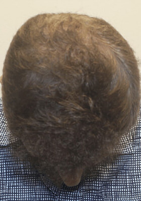 hair transplant photos