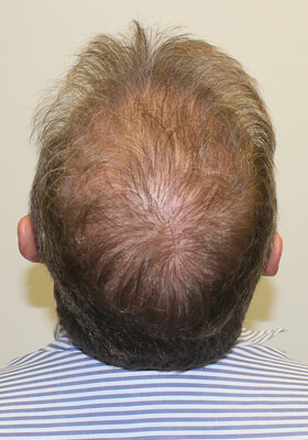 hair transplant photos