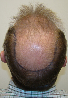 hair transplant photos