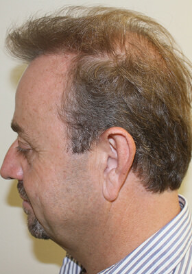 hair transplant before after Photos