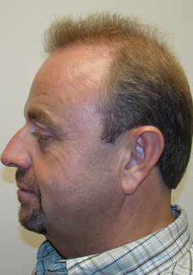 hair transplant photos